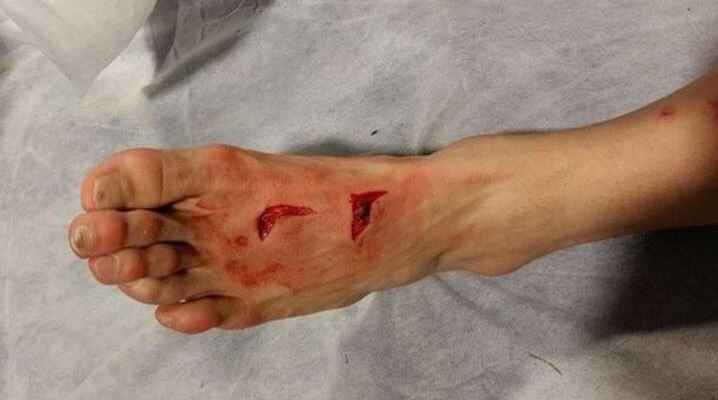 لاعب بورتو يتعرض لجرح خطير في قدمه