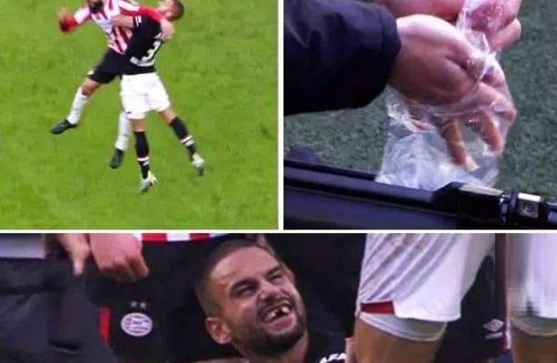 لاعب يفقد أسنانه بعد إلتحام قوي في الدوري الهولندي