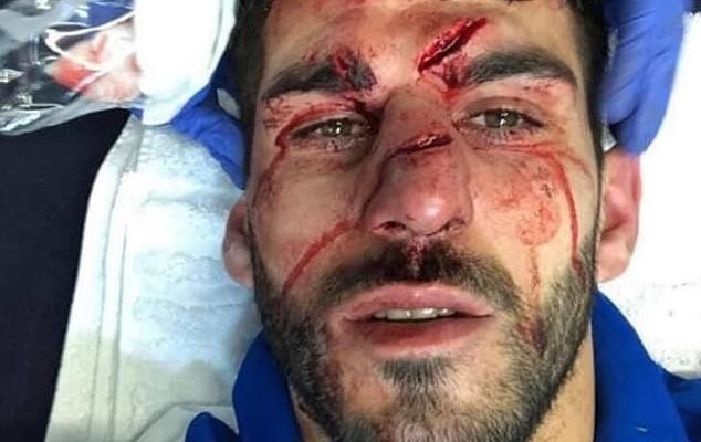 اصابة قاسية للاعب ريدينغ اوليفيرا في مباراة استون فيلا